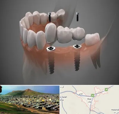 ایمپلنت دیجیتال در بیجار