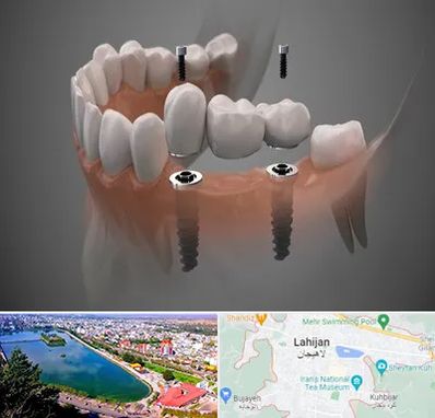 ایمپلنت دیجیتال در لاهیجان