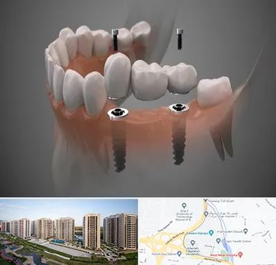 ایمپلنت دیجیتال در المپیک 