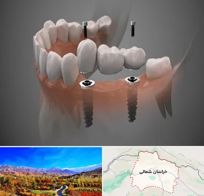 ایمپلنت دیجیتال در خراسان شمالی