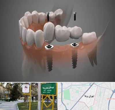 ایمپلنت دیجیتال در تهران ویلا