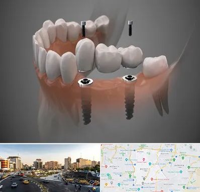ایمپلنت دیجیتال در منطقه 7 تهران