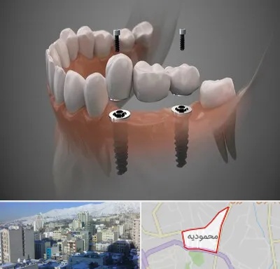 ایمپلنت دیجیتال در محمودیه