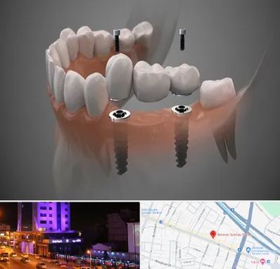 ایمپلنت دیجیتال در آبرسان تبریز