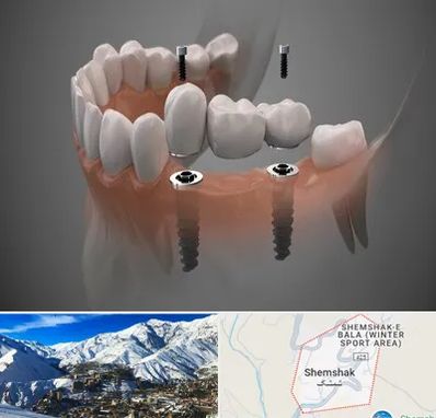 ایمپلنت دیجیتال در شمشک