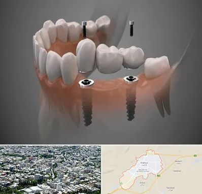 ایمپلنت دیجیتال در شاهرود