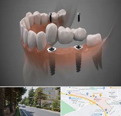 ایمپلنت دیجیتال در مهرویلا کرج