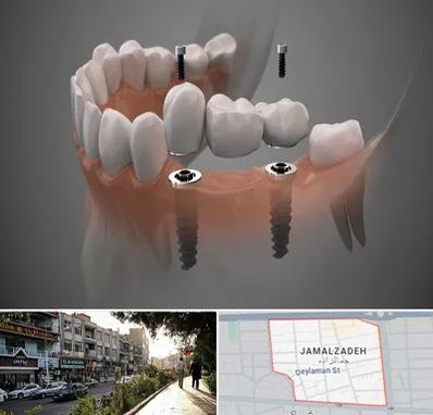 ایمپلنت دیجیتال در خیابان جمالزاده