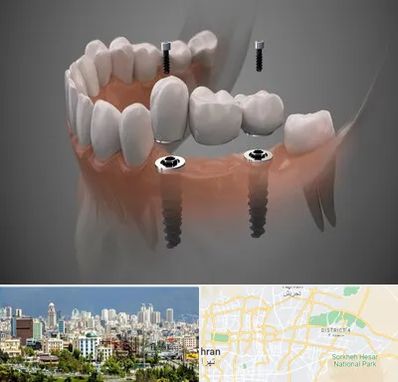 ایمپلنت دیجیتال در شرق تهران 