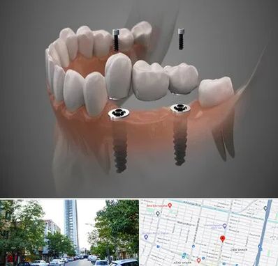 ایمپلنت دیجیتال در امامت مشهد