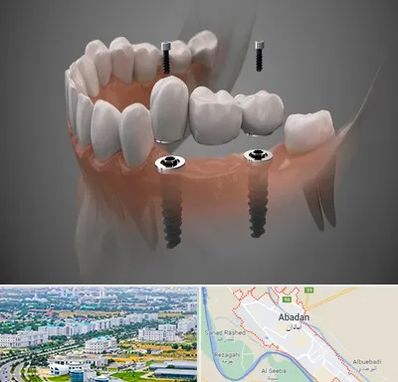 ایمپلنت دیجیتال در آبادان