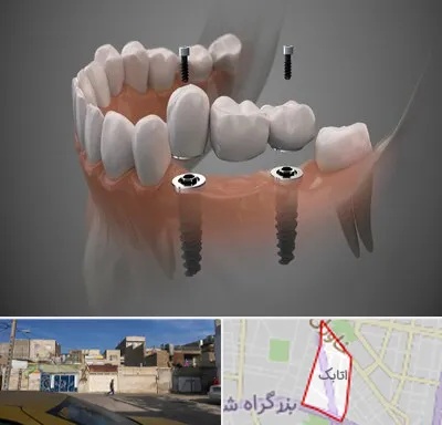 ایمپلنت دیجیتال در اتابک