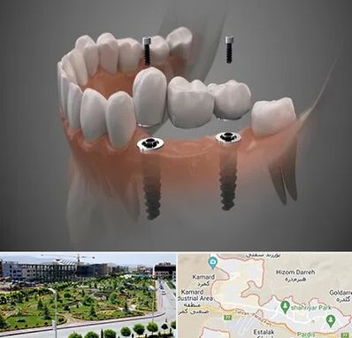 ایمپلنت دیجیتال در پردیس