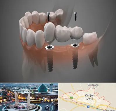 ایمپلنت دیجیتال در زنجان