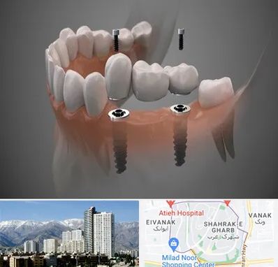 ایمپلنت دیجیتال در شهرک غرب 