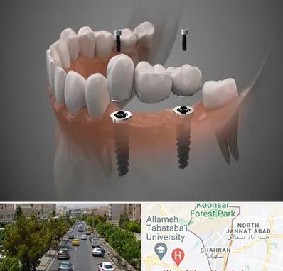 ایمپلنت دیجیتال در شهران 