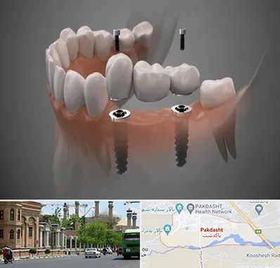 ایمپلنت دیجیتال در پاکدشت