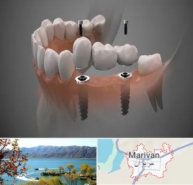 ایمپلنت دیجیتال در مریوان