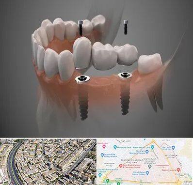 ایمپلنت دیجیتال در شهرک غرب مشهد
