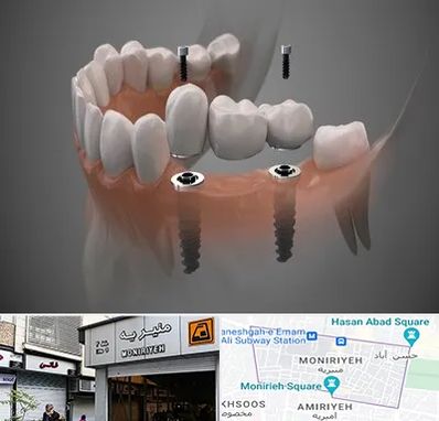 ایمپلنت دیجیتال در منیریه 