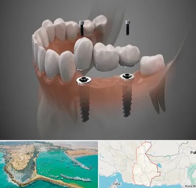ایمپلنت دیجیتال در سیستان و بلوچستان