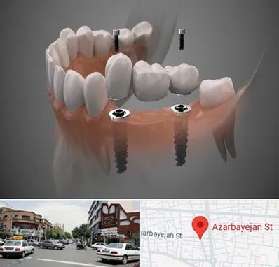 ایمپلنت دیجیتال در خیابان آذربایجان