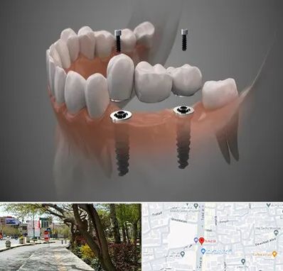 ایمپلنت دیجیتال در خیابان توحید اصفهان