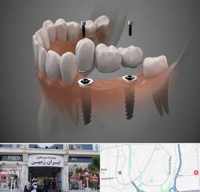 ایمپلنت دیجیتال در ایران زمین