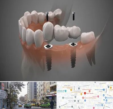 ایمپلنت دیجیتال در فاطمی