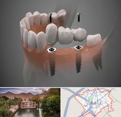 ایمپلنت دیجیتال در دامغان