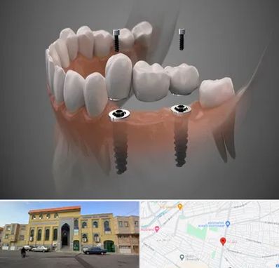 ایمپلنت دیجیتال در زنبیل آباد قم