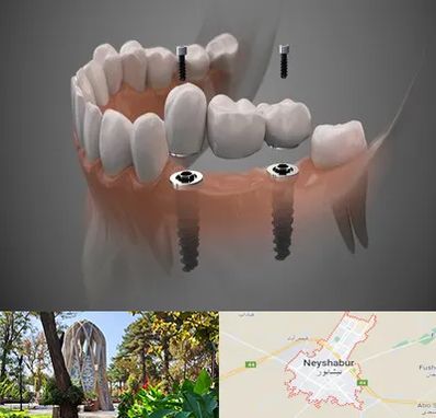 ایمپلنت دیجیتال در نیشابور