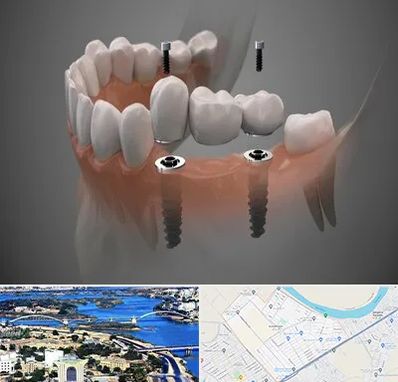 ایمپلنت دیجیتال در کوروش اهواز