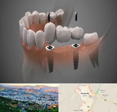 ایمپلنت دیجیتال در سنندج