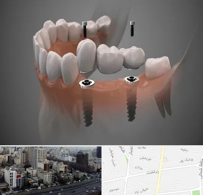ایمپلنت دیجیتال در زرتشت