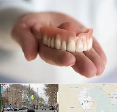 لیفت لثه با لیزر در نظرآباد کرج