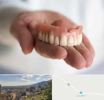 لیفت لثه با لیزر در بوکان تهران