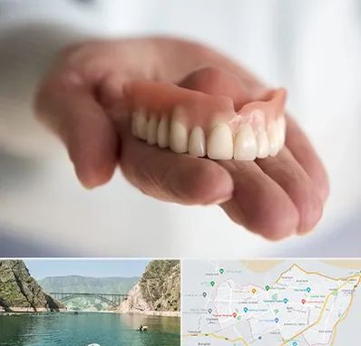 لیفت لثه با لیزر در ایلام