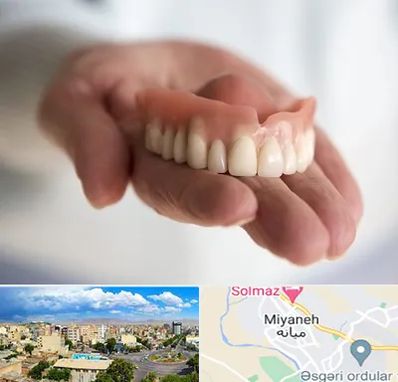 لیفت لثه با لیزر در میانه