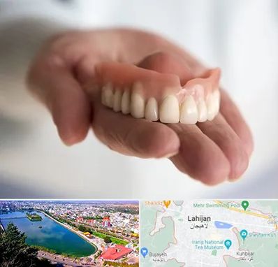 لیفت لثه با لیزر در لاهیجان