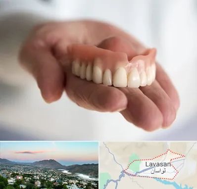 لیفت لثه با لیزر در لواسان