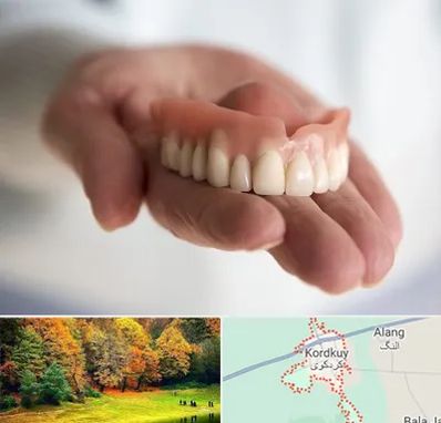 لیفت لثه با لیزر در کردکوی