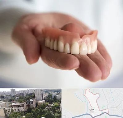 لیفت لثه با لیزر در اوین