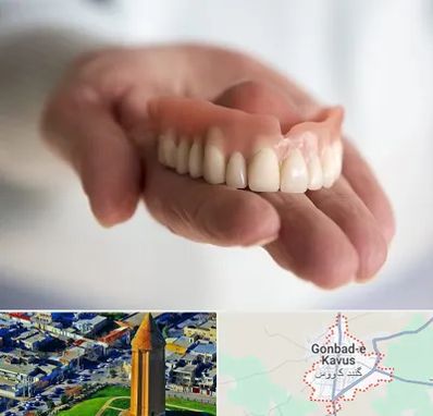 لیفت لثه با لیزر در گنبد کاووس