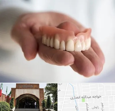لیفت لثه با لیزر در خواجه عبدالله