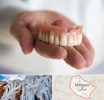 لیفت لثه با لیزر در میگون