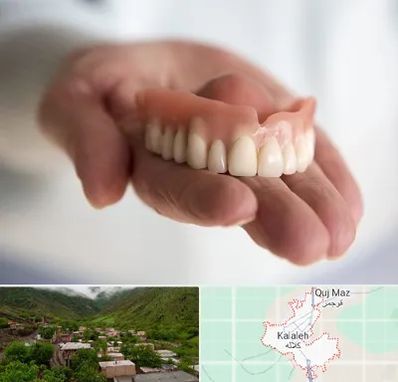 لیفت لثه با لیزر در کلاله