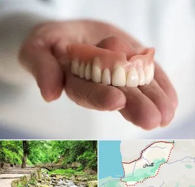 لیفت لثه با لیزر در گلستان