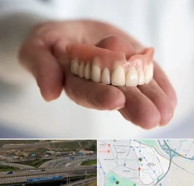 لیفت لثه با لیزر در یاغچیان تبریز