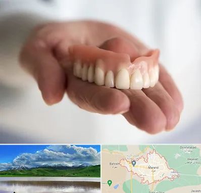 لیفت لثه با لیزر در مرند